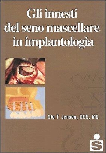 Gli innesti del seno mascellare in implantologia.