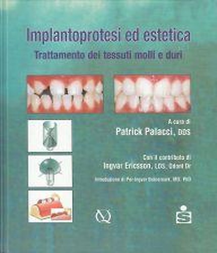 Implantoprotesi ed estetica. Trattamento dei tessuti molli e duri.